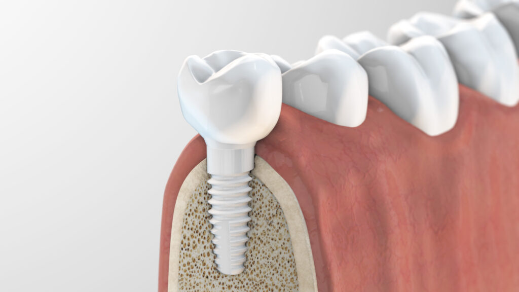 Keramikimplantate, Dr. Franke Berlin